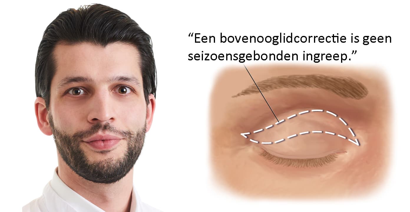 Dit moet je weten over een bovenooglidcorrectie