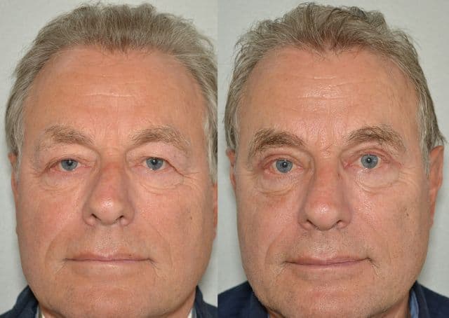 De populairste plastische behandelingen bij mannen