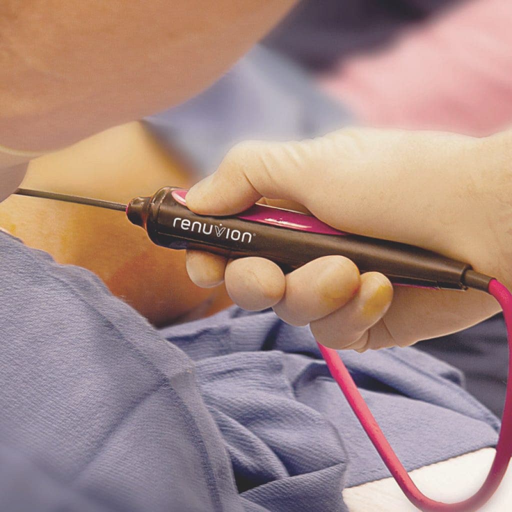 Huidverstrakking met Renuvion (J-Plasma)