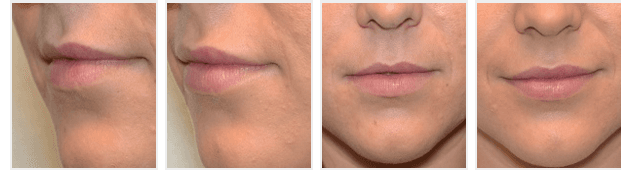 Vollere lippen met injectables