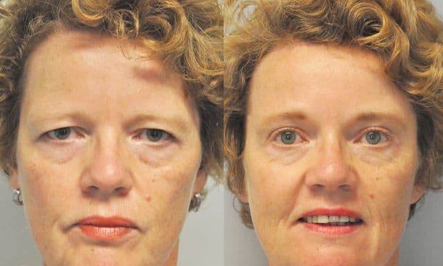 Voorhoofdslift voor en na — resultaat 2